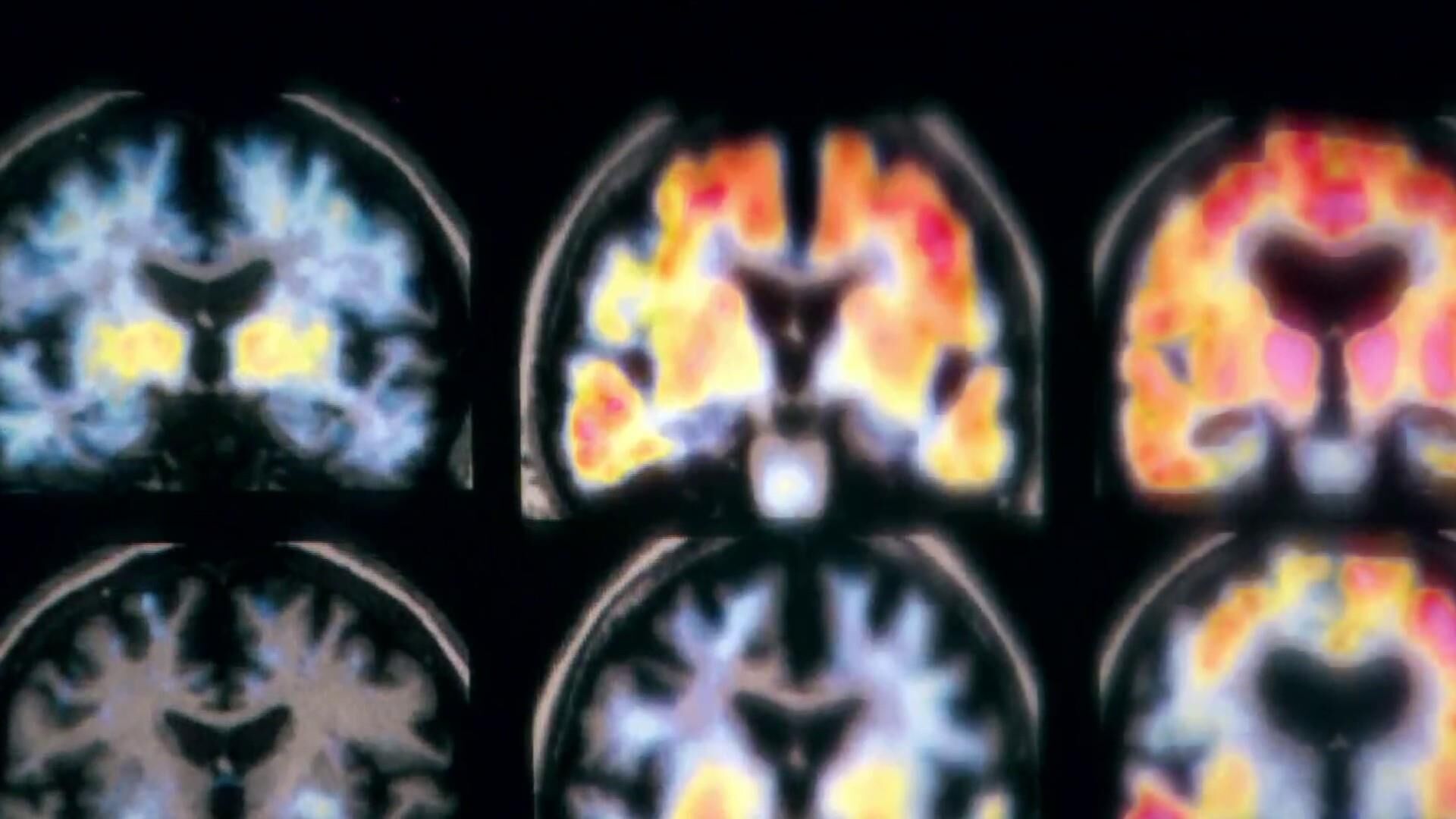 IL House committee unanimously approves bill expanding insurance coverage for Alzheimer's treatment